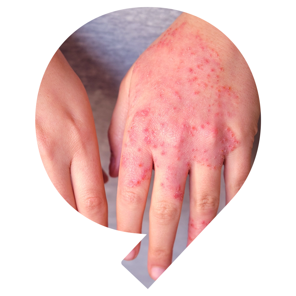 Allergic contact dermatitis - Snö Wellness | Abu Dhabi