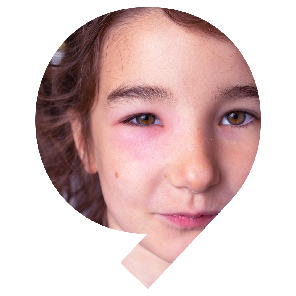 Angioedema - Snö Wellness | Abu Dhabi