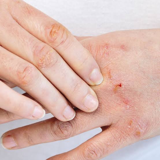 eczema treatments abu dhabi